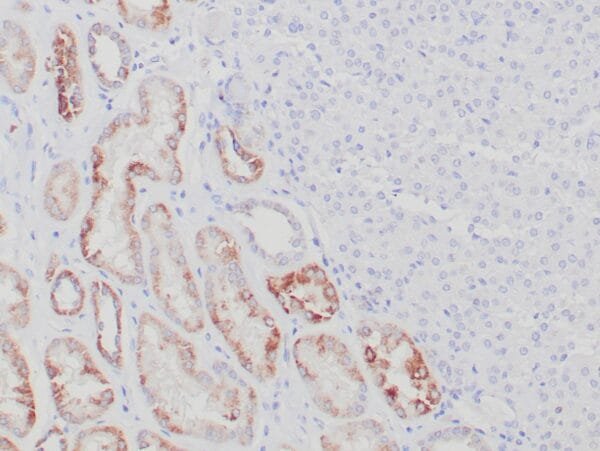 Immunohistochemistry (IHC) : Formalin-fixed, paraffin-embedded succinate dehydrogenase deficient RCC stained with anti-SDHB antibody using peroxidase-conjugate and DAB chromogen. Note the cytoplasmic staining of tumor cells