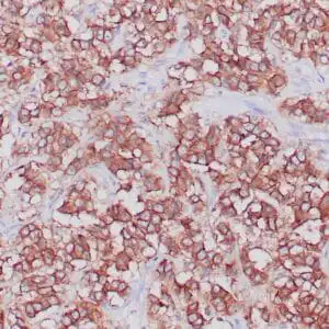 Immunohistochemistry (IHC) : Formalin-fixed, paraffin-embedded human neuroendocrine tumor stained with anti-SSTR2 antibody using peroxidase-conjugate and DAB chromogen. Note cytoplasmic staining of tumor cells