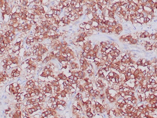 Immunohistochemistry (IHC) : Formalin-fixed, paraffin-embedded human neuroendocrine tumor stained with anti-SSTR2 antibody using peroxidase-conjugate and DAB chromogen. Note cytoplasmic staining of tumor cells