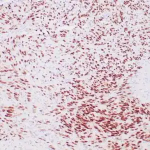 Immunohistochemistry (IHC) : Human malignant melanoma stained with anti-SOX-10 antibody using peroxidase-conjugate and DAB chromogen. Note the nuclear staining of tumor cells.