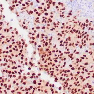 Immunohistochemistry (IHC) : Human malignant melanoma stained with anti-SOX-10 antibody using peroxidase-conjugate and DAB chromogen. Note the nuclear staining of tumor cells.