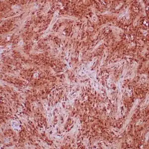 Immunohistochemistry (IHC) : Formalin-fixed, paraffin-embedded human solitary fibrous tumor stained with anti-STAT6 antibody using peroxidase-conjugate and DAB chromogen. Note nuclear and cytoplasmic staining of tumor cells