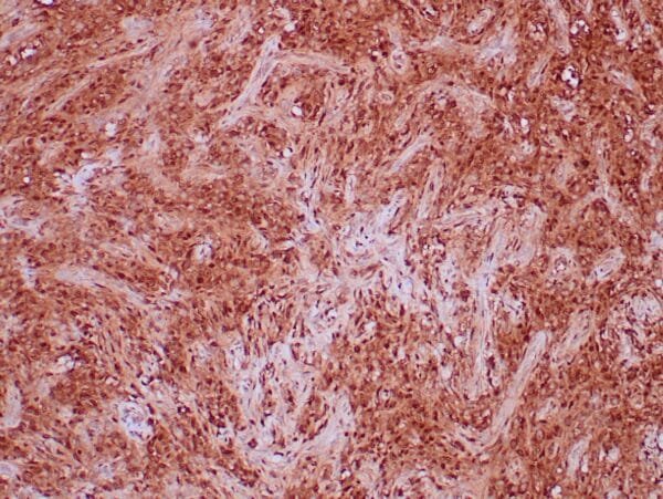 Immunohistochemistry (IHC) : Formalin-fixed, paraffin-embedded human solitary fibrous tumor stained with anti-STAT6 antibody using peroxidase-conjugate and DAB chromogen. Note nuclear and cytoplasmic staining of tumor cells