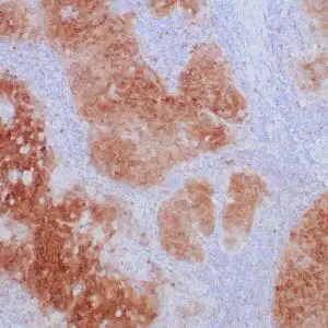 Immunohistochemistry (IHC) : Formalin-fixed, paraffin-embedded human cervical squamous cell carcinoma stained with anti-stathmin using peroxidase-conjugate and DAB chromogen. Note cytoplasmic staining of tumor cells