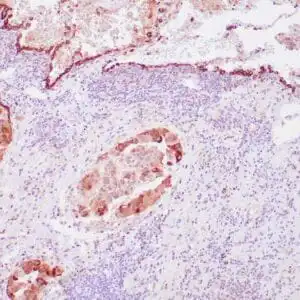 Immunohistochemistry (IHC) : Human lung adenocarcinoma stained with anti-surfactant antibody using peroxidase-conjugate and DAB chromogen. Note the cytoplasmic staining of tumor glands.