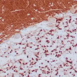 Immunohistochemistry (IHC) : Human neuroendocrine tumor stained with anti-Synaptophysin antibody using peroxidase-conjugate and DAB chromogen. Note the cytoplasmic staining of tumor cells.
