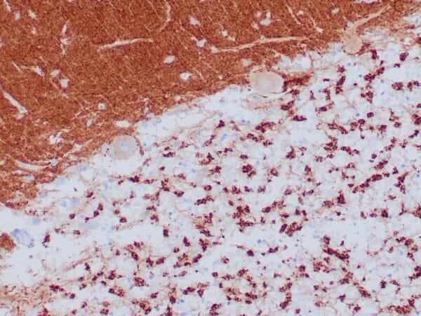 Immunohistochemistry (IHC) : Human neuroendocrine tumor stained with anti-Synaptophysin antibody using peroxidase-conjugate and DAB chromogen. Note the cytoplasmic staining of tumor cells.