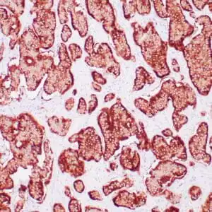 Immunohistochemistry (IHC) : Human neuroendocrine tumor stained with anti-Synaptophysin antibody using peroxidase-conjugate and DAB chromogen. Note the cytoplasmic staining of tumor cells.