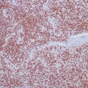 Immunohistochemistry (IHC) : Human type B1 thymoma stained with anti-TdT antibody. Note the immature T-cells are positive.