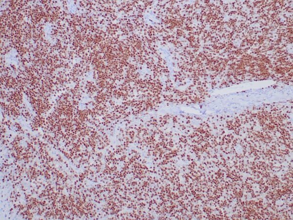 Immunohistochemistry (IHC) : Human type B1 thymoma stained with anti-TdT antibody. Note the immature T-cells are positive.