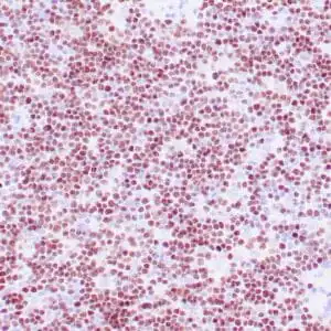 Immunohistochemistry (IHC) : Human type B1 thymoma stained with anti-TdT antibody. Note the immature T-cells are positive.