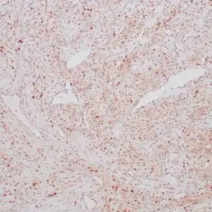 Immunohistochemistry (IHC) : Formalin-fixed, paraffin-embedded human ovarian sclerosing stromal tumor stained with anti-TFE3 antibody using peroxidase-conjugate and DAB chromogen. Note nuclear staining of tumor cells