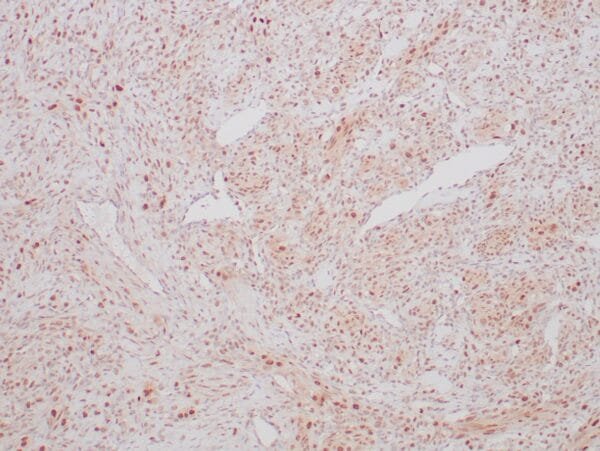 Immunohistochemistry (IHC) : Formalin-fixed, paraffin-embedded human ovarian sclerosing stromal tumor stained with anti-TFE3 antibody using peroxidase-conjugate and DAB chromogen. Note nuclear staining of tumor cells