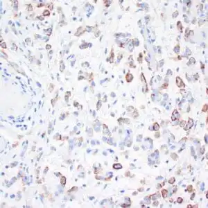 Immunohistochemistry (IHC) : Human urothelial carcinoma stained with anti-Thrombomodulin antibody using peroxidase-conjugate and DAB chromogen. Note the cytoplasmic staining of tumor cells.