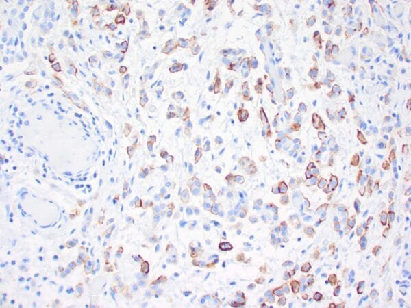 Immunohistochemistry (IHC) : Human urothelial carcinoma stained with anti-Thrombomodulin antibody using peroxidase-conjugate and DAB chromogen. Note the cytoplasmic staining of tumor cells.