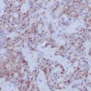 Immunohistochemistry (IHC) : Human urothelial carcinoma stained with anti-thymidylate synthase (TS) antibody using peroxidase-conjugate and DAB chromogen. Note the cytoplasmic staining of tumor cells.