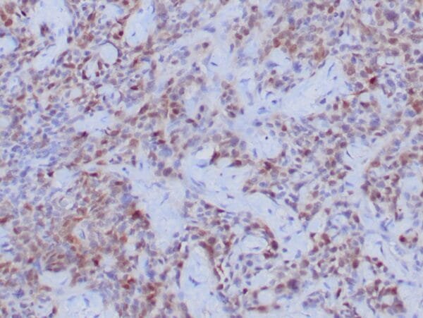 Immunohistochemistry (IHC) : Human urothelial carcinoma stained with anti-thymidylate synthase (TS) antibody using peroxidase-conjugate and DAB chromogen. Note the cytoplasmic staining of tumor cells.