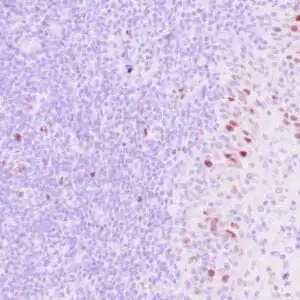 Immunohistochemistry (IHC) : Human colon carcinoma stained with anti-thymidylate synthase (TS) antibody using peroxidase-conjugate and DAB chromogen. Note the cytoplasmic staining of tumor cells.