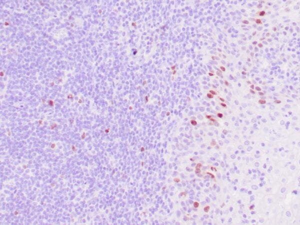 Immunohistochemistry (IHC) : Human colon carcinoma stained with anti-thymidylate synthase (TS) antibody using peroxidase-conjugate and DAB chromogen. Note the cytoplasmic staining of tumor cells.