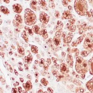 Immunohistochemistry (IHC) : Human thyroid gland stained with anti-thyroglobulin antibody using peroxidase-conjugate and DAB chromogen. Note the cytoplasmic of follicular cells.