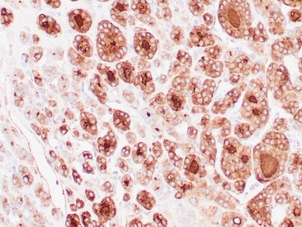 Immunohistochemistry (IHC) : Human thyroid gland stained with anti-thyroglobulin antibody using peroxidase-conjugate and DAB chromogen. Note the cytoplasmic of follicular cells.