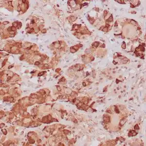 Immunohistochemistry (IHC) : Formalin-fixed, paraffin-embedded human pituitary adenoma stained with anti-TSH antibody  using peroxidase-conjugate and DAB chromogen. Note the cytoplasmic staining of tumor cells