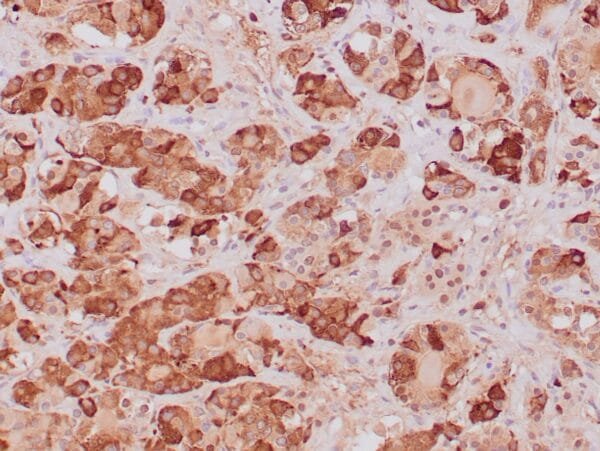 Immunohistochemistry (IHC) : Formalin-fixed, paraffin-embedded human pituitary adenoma stained with anti-TSH antibody  using peroxidase-conjugate and DAB chromogen. Note the cytoplasmic staining of tumor cells