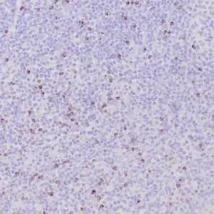 Immunohistochemistry (IHC) : Human nasal T/NK cell lymphoma stained with anti-TIA-1 antibody using peroxidase-conjugate and DAB chromogen. Note the cytoplasmic granular staining of lymphoma cells.