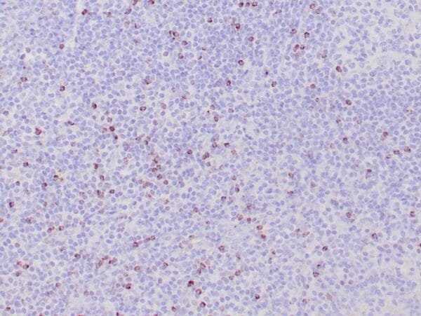 Immunohistochemistry (IHC) : Human nasal T/NK cell lymphoma stained with anti-TIA-1 antibody using peroxidase-conjugate and DAB chromogen. Note the cytoplasmic granular staining of lymphoma cells.