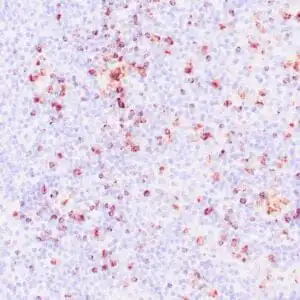 Immunohistochemistry (IHC) : Human nasal T/NK cell lymphoma stained with anti-TIA-1 antibody using peroxidase-conjugate and DAB chromogen. Note the cytoplasmic granular staining of lymphoma cells.