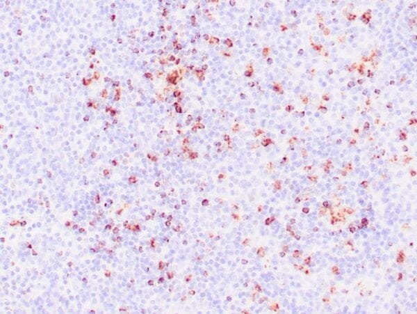 Immunohistochemistry (IHC) : Human nasal T/NK cell lymphoma stained with anti-TIA-1 antibody using peroxidase-conjugate and DAB chromogen. Note the cytoplasmic granular staining of lymphoma cells.