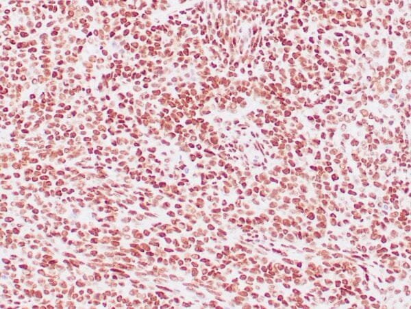 Immunohistochemistry (IHC) : Human synovial sarcoma stained with anti-TLE1 antibody using peroxidase-conjugate and DAB chromogen. Note nuclear staining of tumor cells.