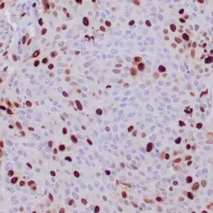 Immunohistochemistry (IHC) : Formalin-fixed, paraffin-embedded human squamous cell carcinoma stained with anti-Topoisomerase IIa  antibody using peroxidase-conjugate and DAB chromogen. Note nuclear staining of tumor cells