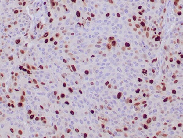 Immunohistochemistry (IHC) : Formalin-fixed, paraffin-embedded human squamous cell carcinoma stained with anti-Topoisomerase IIa  antibody using peroxidase-conjugate and DAB chromogen. Note nuclear staining of tumor cells