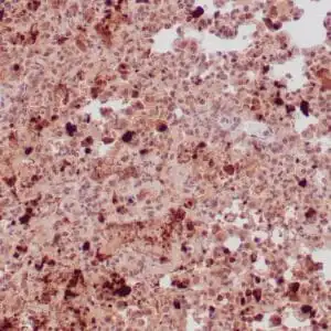 Immunohistochemistry (IHC) : Human lung infected with toxoplasma gondii stained with anti-toxoplasma gondii antibody using peroxidase-conjugate and DAB chromogen. Note positive staining of organisms..