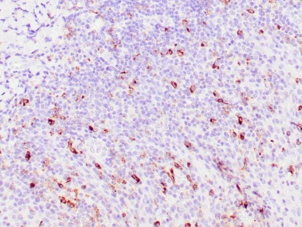 Immunohistochemistry (IHC) : Human spleen involved by hairy cell leukemia stained with anti-TRAcP antibody using peroxidase-conjugate and DAB chromogen. Note the cytoplasmic staining of leukemia cells.