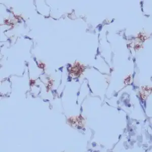 Immunohistochemistry (IHC) : Human lung infected with treponema organisms stained with anti-treponema pallidum using peroxidase-conjugate and DAB chromogen. Note the clusters of slender organisms.