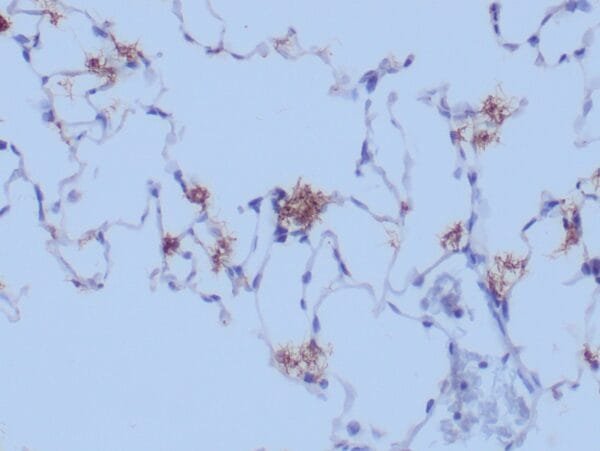 Immunohistochemistry (IHC) : Human lung infected with treponema organisms stained with anti-treponema pallidum using peroxidase-conjugate and DAB chromogen. Note the clusters of slender organisms.