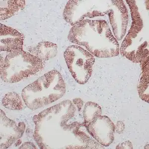 Immunohistochemistry (IHC) : Formalin-fixed, paraffin-embedded colon carcinoma stained with anti-TROP2 antibody using peroxidase-conjugate and DAB chromogen. Note the cell surface staining of tumor cells