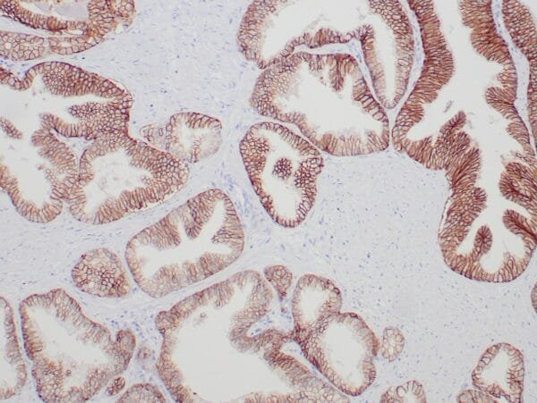 Immunohistochemistry (IHC) : Formalin-fixed, paraffin-embedded colon carcinoma stained with anti-TROP2 antibody using peroxidase-conjugate and DAB chromogen. Note the cell surface staining of tumor cells