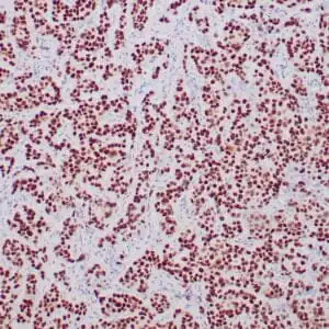 Immunohistochemistry (IHC) : Formalin-fixed, paraffin-embedded human breast carcinoma stained with anti-TRPS1 antibody using peroxidase-conjugate and DAB chromogen. Note the nuclear staining of tumor cells
