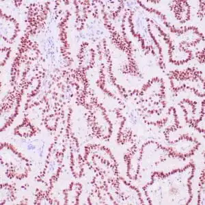 Immunohistochemistry (IHC) : Human lung adenocarcinoma stained with anti-TTF-1 antibody using peroxidase-conjugate and DAB chromogen. Note the nuclear staining of tumor cells.