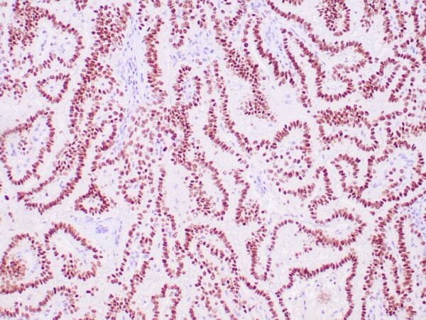 Immunohistochemistry (IHC) : Human lung adenocarcinoma stained with anti-TTF-1 antibody using peroxidase-conjugate and DAB chromogen. Note the nuclear staining of tumor cells.