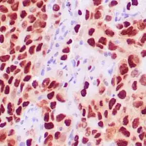 Immunohistochemistry (IHC) : Human lung adenocarcinoma stained with anti-TTF-1 antibody using peroxidase-conjugate and DAB chromogen. Note the nuclear staining of tumor cells.