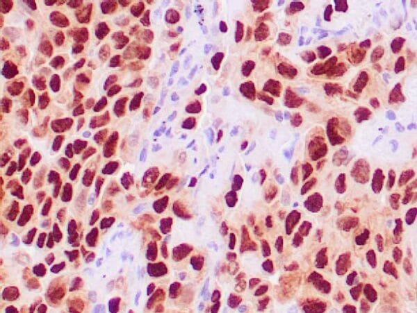 Immunohistochemistry (IHC) : Human lung adenocarcinoma stained with anti-TTF-1 antibody using peroxidase-conjugate and DAB chromogen. Note the nuclear staining of tumor cells.