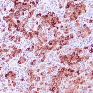 Immunohistochemistry (IHC) : Human melanoma stained with anti-tyrosinase antibody using peroxidase-conjugate and DAB chromogen. Note the cytoplasmic staining of tumor cells.