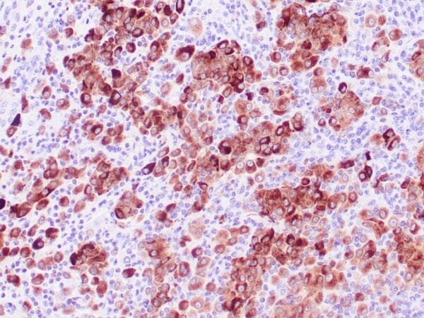 Immunohistochemistry (IHC) : Human melanoma stained with anti-tyrosinase antibody using peroxidase-conjugate and DAB chromogen. Note the cytoplasmic staining of tumor cells.