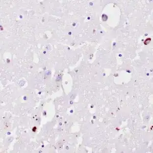 Immunohistochemistry (IHC) : Human brain hippocampus stained with anti-ubiquitin antibody using peroxidase-conjugate and DAB chromogen. Note the cytoplasmic staining of few neurons..