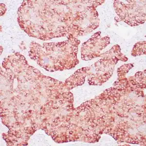 Immunohistochemistry (IHC) : Human bladder urothelial carcinoma stained with anti-uroplakin antibody using peroxidase-conjugate and DAB chromogen. Note the cytoplasmic staining of tumor cells.
