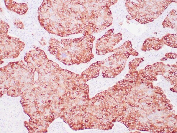 Immunohistochemistry (IHC) : Human bladder urothelial carcinoma stained with anti-uroplakin antibody using peroxidase-conjugate and DAB chromogen. Note the cytoplasmic staining of tumor cells.